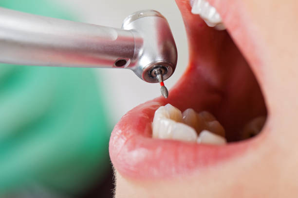 Best Emergency Treatment for Dental Infections or Abscesses in Grape Creek, TX